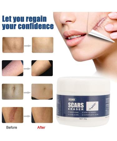 Scar Gel - Skin Repair and Removal Treatment for Face, Body, Surgery, Burns, Stretch Marks - Buy Online on SooperMarket.com