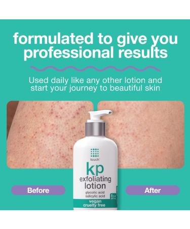 12% Glycolic Acid Body Lotion for Keratosis Pilaris | Exfoliating Moisturizer for Rough & Bumpy Skin | Redness Reduction | 8 oz - Buy Online on SooperMarket.com