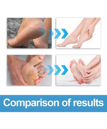 Foot Cream For Very Dry Feet Natural Foot Cream Foot Cream For Calluses And Hard Skin Cracked Heel Repair Balm Coconut Oil Foot Moisturiser Callus Remover Soften For Feet Knees Hand - 50g - Buy Online on SooperMarket.com
