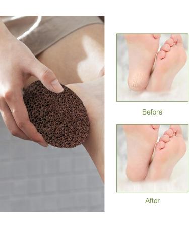 2 Pcs Pumice Stone Dead Hard Skin Callus Remover for Feet/Hands/Body 2 Different Coarse Levels Foot Scrubber Stone with Dry Bath Brush - Buy Online on SooperMarket.com