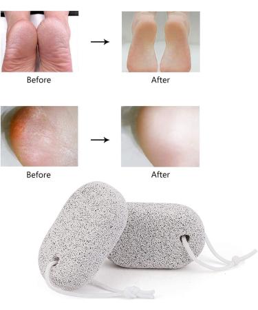 PHOGARY Natural Pumice Stone for Feet 3 PCS - Lava Pedicure Tools for Callus Removal on Feet and Hands - Exfoliating Foot File for Dead Skin Removal - Buy Online on SooperMarket.com