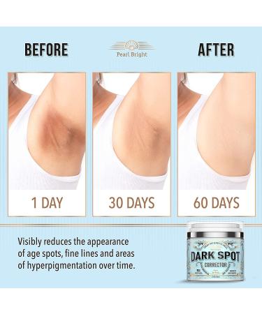 PearlBright Dark Spot Remover for Face & Body - Natural Skincare for Sensitive Areas - Made in USA - With Licorice, Mulberry Extract, Arbutin - 1.7oz - Buy Online on SooperMarket.com