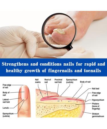 Fungal Nail Treatment 30ML Nail Fungus Serum for Toenail Extra Strong Gentle Anti Fungal Nail Serum Protects Thick Broken Discolored Nails Restoring Healthy Nails For Finger And Toe Nail Fungal - Buy Online on SooperMarket.com