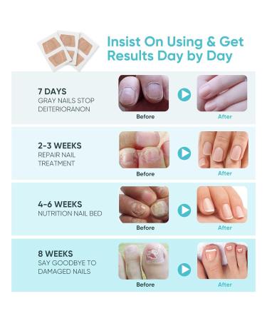 Nighttime Renewal Toe Nail Patches for Fungus - Fast & Effective Foot Care (16 Patches) - Buy Online on SooperMarket.com