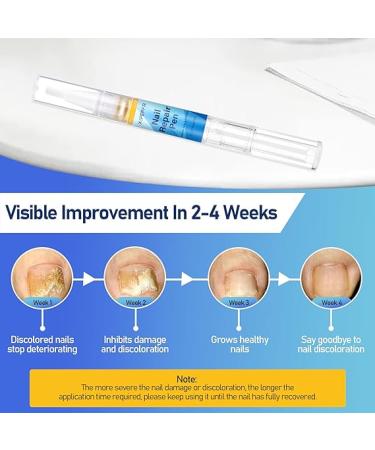 XIFEPFR Toenail Repair Pen - Nail Fingernail Repair Pen for Thick  Broken  Discolored Nails - Restores Healthy Strong Nails - 4PCS - Buy Online on SooperMarket.com