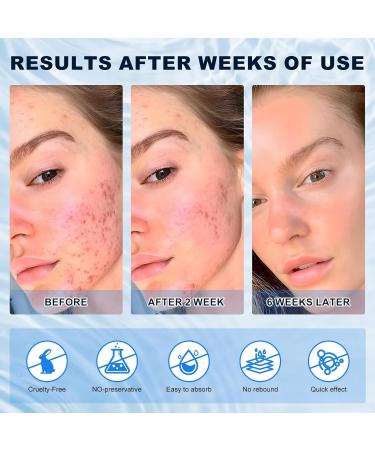 Azelaic Acid 10% Cream - Effective Acne & Rosacea Treatment for Clear Skin | Reduce Redness Breakouts & Pigmentation - Buy Online on SooperMarket.com