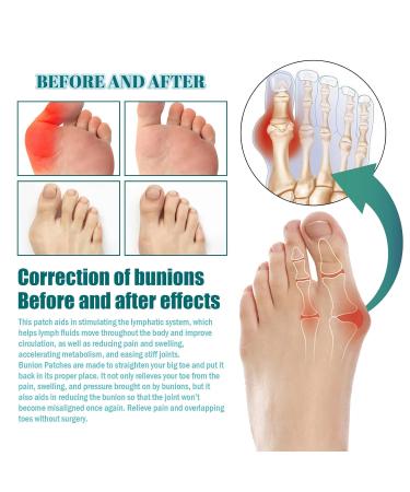Bunion Relief Fit Patch - Pain Relieving Bunion Corrector Pads (1 Box) - Buy Online on SooperMarket.com