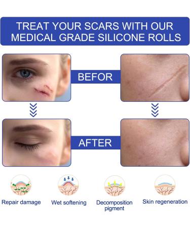 Silicone Scar Sheets 1.6x120 - Scar Removal Tape for Burn, Acne, C-Section & Surgery - Reusable & Washable - Buy Online on SooperMarket.com
