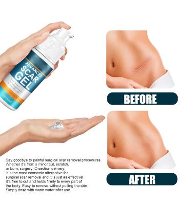Scar Repair Gel - Mild Treatment Cream for Fading Scars, Stretch Marks & Wrinkles - Buy Online on SooperMarket.com