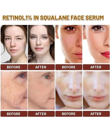 Retinol1% In Squalane Retinol Serum For Face Retinol Serum High-Strength Face Serum for Women Anti-Aging Face Serum Fade Fine Lines Acne Reduced Skin Brightening Face Serums For Skin Care - Buy Online on SooperMarket.com