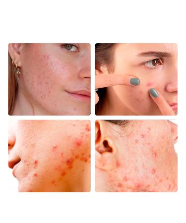 2024 New Acne Cover Patch Spot Stickers for Face & Skin - 36 Patches | Effective Acne Treatment | Fast Shipping Internationally - Buy Online on SooperMarket.com