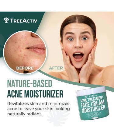 TreeActiv Acne Treatment Face Cream with Salicylic Acid & Tea Tree Oil - 90 Day Supply - Buy Online on SooperMarket.com