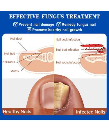Fungal Nail Treatment 30ML Nail Fungus Serum for Toenail Extra Strong Gentle Anti Fungal Nail Serum Protects Thick Broken Discolored Nails Restoring Healthy Nails For Finger And Toe Nail Fungal - Buy Online on SooperMarket.com
