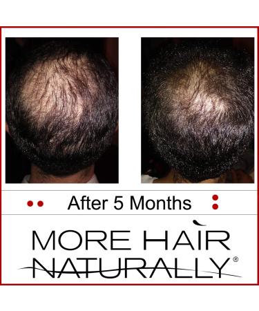More Hair Naturally 9 - Advanced Stem Cell Therapy for Thinning Hair - Buy Online on SooperMarket.com