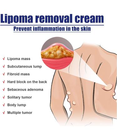Lipoma Removal Cream 0.7oz | Anti-Inflammatory Cellulite Treatment for Skin | Easy Absorption Formula | Alleviate Lipoma Mass - Buy Online on SooperMarket.com