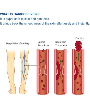 50g Natural Varicose Veins Cream | Leg Circulation & Spider Vein Remover | Cooling Effect | Ointment - Buy Online on SooperMarket.com