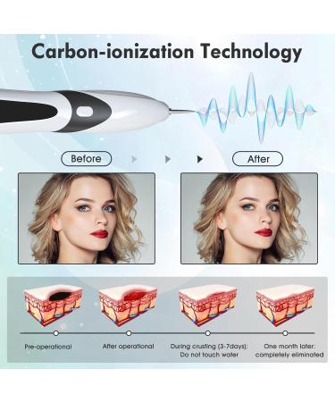 Aceshop Skin Tags Removal Pen Professional Mole Remover Pen Kit with 9 Strength Levels & Replaceable Needles USB Rechargeable Mole Remover Pen Kit Plasma Pen for Wart Freckle Nevus (White) - Buy Online on SooperMarket.com
