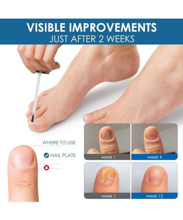 Fungal Nail Treatment Serum Extra Strong Antifungal Nail Treatment for Toenails/Fingernails Improve Thickening/Yellowed/Discolored Nails Original(nail Fungal Serum) - Buy Online on SooperMarket.com
