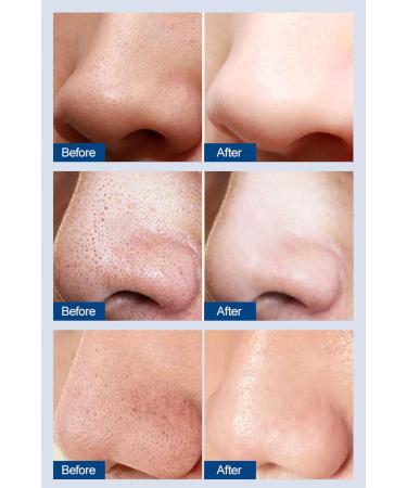 3-Step Blackhead Removal Nose Patch Deep Cleansing Blackhead Remover Nose Strips Newly Upgraded No Peeling No Pain Gentle to The Skin - Buy Online on SooperMarket.com