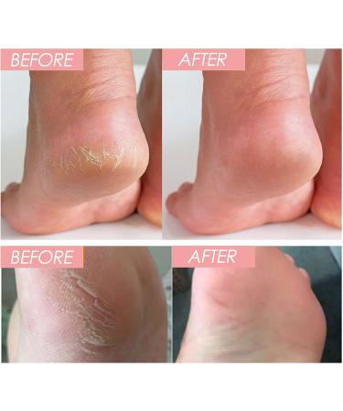 Cracked Heel Repair Cream Stick Foot Moisturizing Stick Foot Cream For Very Dry Feet Foot Cream For Calluses And Hard Skin Foot Moisturiser Callus Remover Soften For Feet Knees Hand - Buy Online on SooperMarket.com