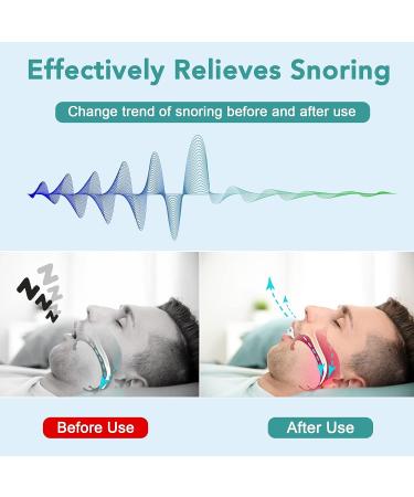 Anti Snoring Mouthpiece - Effective Snoring Solution for Men and Women - Buy Online on SooperMarket.com