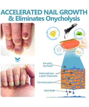 Nail Growth and Repair Serum Nail Strengthening and Growth Conditioner Nourish Strengthen And Revitalize Your Nails (1 Pcs) - Buy Online on SooperMarket.com