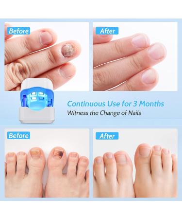 Incley Nail Fungus Cleaning Laser Device - Effective Blue Light Therapy for Toenails & Onychomycosis - Rechargeable Fungus Remover for Home Use - Buy Online on SooperMarket.com