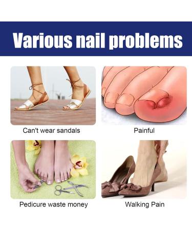Ingrown Toenail Treatment - 30ML Ingrown Toenail Correction Drops - Nail Helper Ingrowth Toenail Treatment Oil - Trimming Toenail Softening Drops - Nail Fungal Treatment - Buy Online on SooperMarket.com