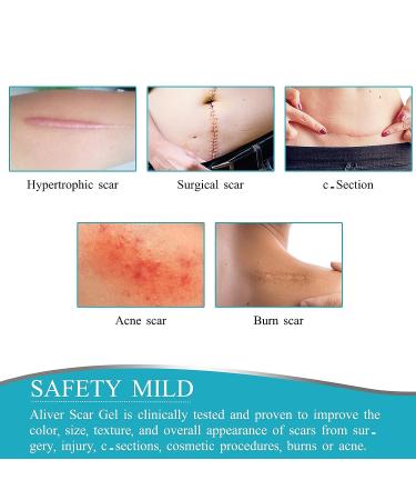 3Meters Silicone Scar Roll for C-Section Surgery Burn Keloid Acne - Drug-Free Professional Scar Sheets - Buy Online on SooperMarket.com