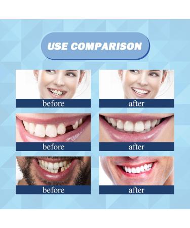 30 ml Tooth Repair Kit | Temporary Tooth Replacement & Moldable Thermal Fitting Beads for Missing Broken Teeth & Dentures - Buy Online on SooperMarket.com