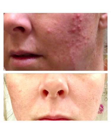 Mandelic Acid Peel 40% for Face - Professional Intense Chemical Peel for Rosacea, Acne, Hyperpigmentation & Melasma - Alpha Hydroxy Acid Skin Brightening Treatment - 1 Fl Oz - Buy Online on SooperMarket.com