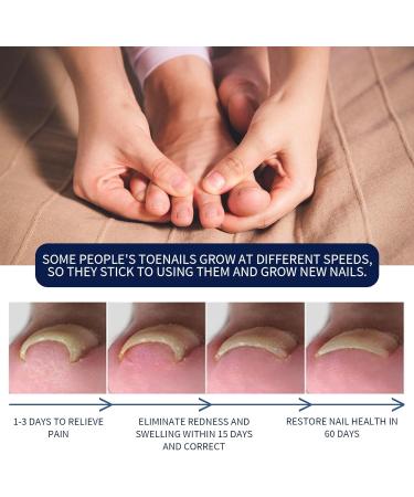 Ingrown Toenail Treatment and Removal Relief Oil - Nail Growth and Fungal Corrector - Buy Online on SooperMarket.com