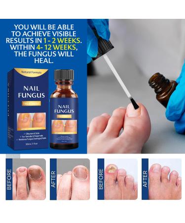 Extra Strength Toe Nail Fungus Treatment - Effective Nail Repair Solution for Healthy Nails - Buy Online on SooperMarket.com