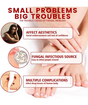 TBeautfave Fungal Nail Treatment Antifungal Nail Treatment Toe Nail Fungal Treatment Fungal Nail Treatment for Toenails Extra Strong Nail Repair and Strengthen Fix & Renew Damaged Broken Nails - Buy Online on SooperMarket.com