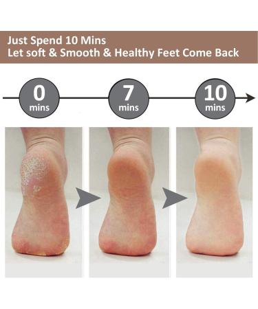 Dacvgog Pedicure for Feet Callus Remover Rasp Colossal Foot Scrubber Foot Health Professional Nursing - Buy Online on SooperMarket.com