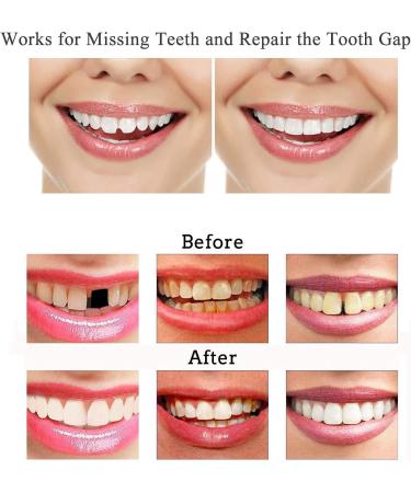 OTCPP Temporary Tooth Repair Kit - Teeth Veneers for Missing Tooth Support - Buy Online on SooperMarket.com
