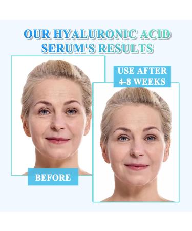 Hyaluronic Acid Serum for Face 95% Hyaluronic Acid & Vitamin C+E - Anti Wrinkle + Anti Aging Hydrochloric Acid Face Serum - Antiaging Hydrating Serums Skincare Dark Spot Remover for Face - Buy Online on SooperMarket.com