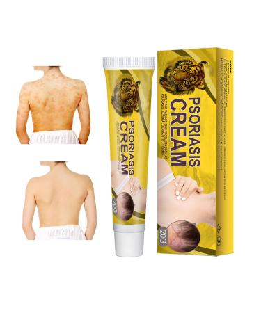 Doxenem Eczema Cure Cream Psoriasis Eczema Cream Control Reoccurrence Tinea Versicolor Treatment Cream Eczema Cream for Adults to Cure Dark Spots for Relief Irritated Skin for All Skin