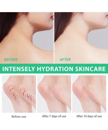 Urea Foot Cream Ultra Moisturizing 40% Urea Foot Cream Plus Deeply Hydrating Heel Balm For Callous Removal and Soften For dry Cracked Feet Heels and Hands - 100g 100 Grams - Buy Online on SooperMarket.com
