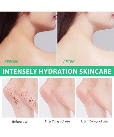 Urea Cream 40% with 2% Salicylic Acid - Best Callus Remover & Foot Repair Lotion for Dry Cracked Heels Knees & Hands (5.29 OZ) - Deep Moisturization & Skin Renewal - International Shipping Available - Buy Online on SooperMarket.com