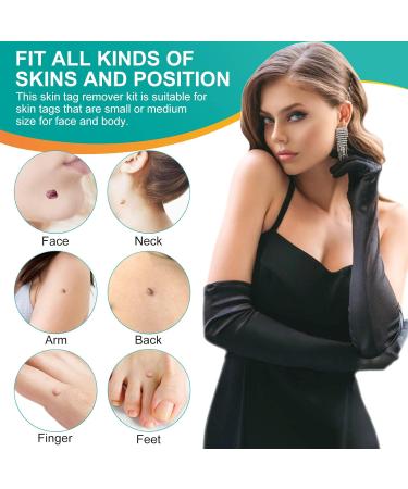 Skin Tag Remover 2 in 1 Kit for Medium/Large Skin Tags - Painless Mole Wart Treatment Tool for Face and Body - Buy Online on SooperMarket.com