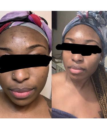 Dark Spot Corrector & Brightening Serum with Kojic Acid, Vitamin C, Salicylic Acid & More | Melasma Treatment Cream by Admire My Skin - Buy Online on SooperMarket.com