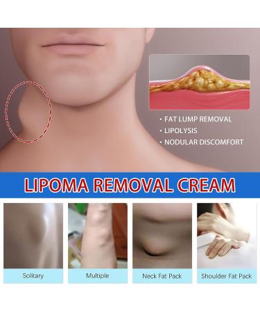 Lipoma Removal Cream 20g - Natural Treatment for Lipoma Care & Discomfort - Buy Online on SooperMarket.com