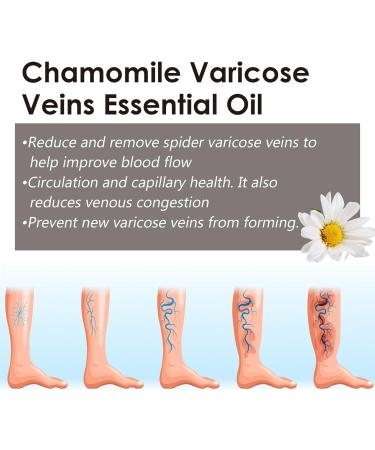 Marronie Oil for Varicose Veins Marronie Chamomile Essential Oil for Varicose Veins 1/3/5 Pack Marronie Oil Varicose Veins (3pcs) - Buy Online on SooperMarket.com