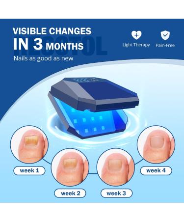 Nail Fungus Cleaning Device for Multiple fingers 905nm Infrared Light + 470nm Blue Light Highly Effective Treatment for Home Use Treat and effectively prevent (Navy) - Buy Online on SooperMarket.com
