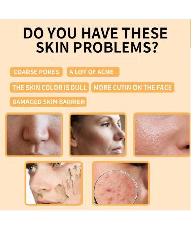 Glycolic Acid Toner Repair Acne & Anti Aging Face Toner Glycolic Acid 7% Dark Spot Remover Pore Treatment Improve Blemishes for Blemishes and Acne for Combination and Oily Skin 100ml - Buy Online on SooperMarket.com