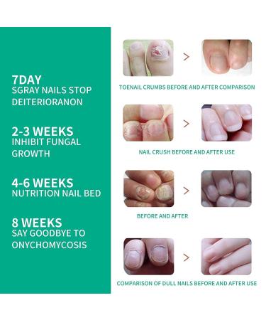 Kerassentials Toenail Treatment Oil - 4PCS Natural Nail Treatment for Repairing and Strengthening - Buy Online on SooperMarket.com