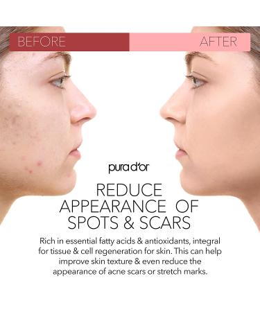 PURA DOR Organic Scar & Stretch Mark Treatment Oil | 1oz For Skin - Rosehip, Wheat Germ, Argan, Tamanu, Carrot, Rosemary, Lavender, Geranium, Patchouli, Sage - Buy Online on SooperMarket.com