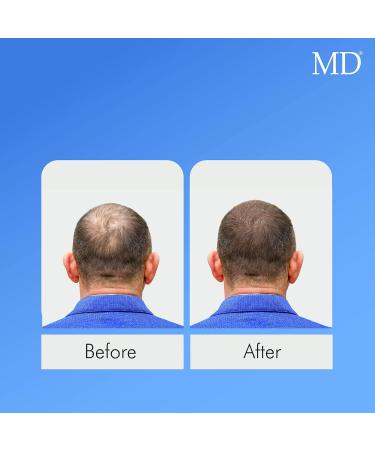 MD Hair Restoration Two Step System - Follicle Activator & Energizer for Hair Thinning Regrowth & Nourishment | Ideal for Men & Women - International Shipping Available - Buy Online on SooperMarket.com
