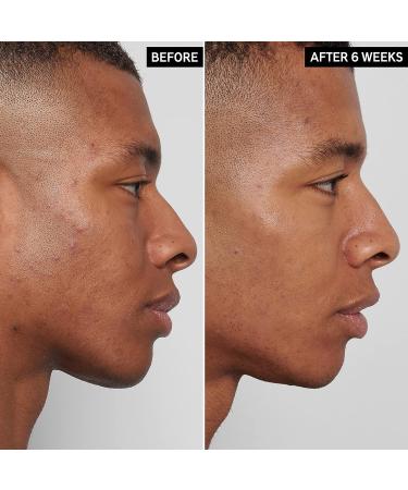 The INKEY List Mandelic Acid Treatment - 10% Mandelic Acid for Hyperpigmentation & Post Breakout Marks - Buy Online on SooperMarket.com